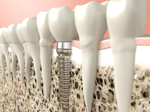 Healthy single dental implant after failure and salvage