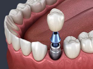 Animation of dental implant supported crown placement