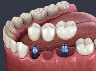 Animation of dental implant supported bridge placement