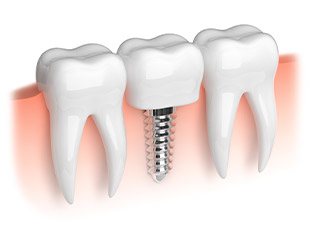 Animation of mini dental implant supported dental crown