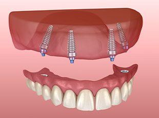Animation of All-on-4 denture placement
