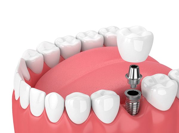 3D illustration of implant, abutment, and crown
