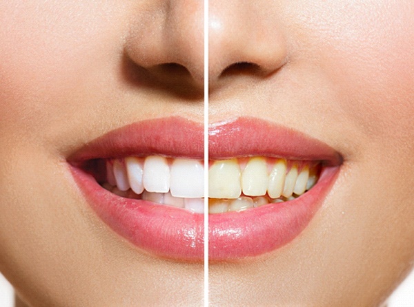 A before and after image of a person’s teeth after undergoing in-practice whitening