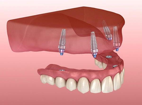 A digital image of an All-on-4 denture being placed on the upper arch and secured to four dental implants