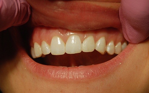 Smile with canine tooth in place