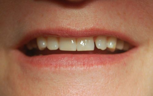 Smile with impacted canine tooth