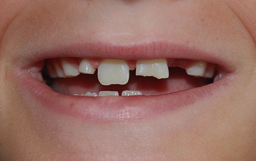 Broken front tooth in child's smile
