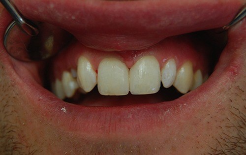 Reduced spacing between teeth