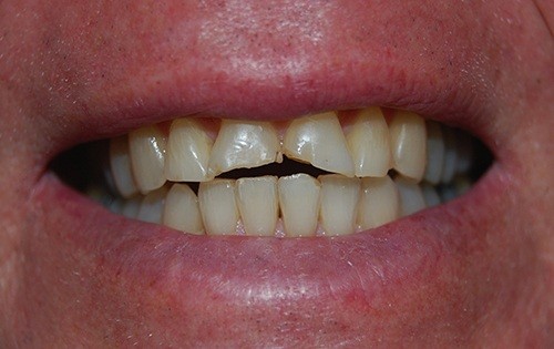 Severly damaged front teeth
