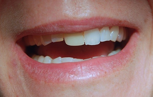 Irregularly shaped and uneven teeth