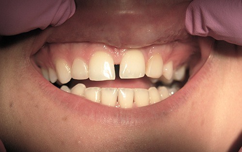 Large space between front teeth