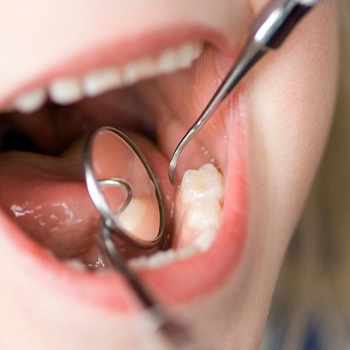 Closeup of dental instruments examining a child’s teeth