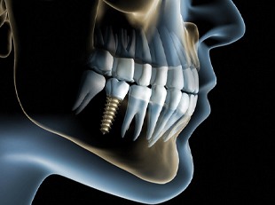 Computer-generated image of implant surgically inserted into jaw