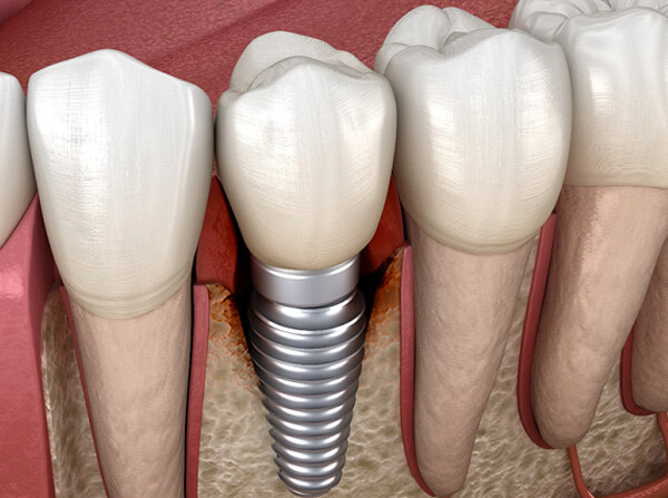 Illustration of peri-implantitis, a leading cause of dental implant failure