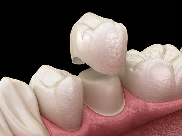 Image of a dental crown fixing a tooth.