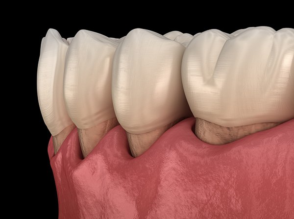 Illustration showing tissue being grafted on to receding gums