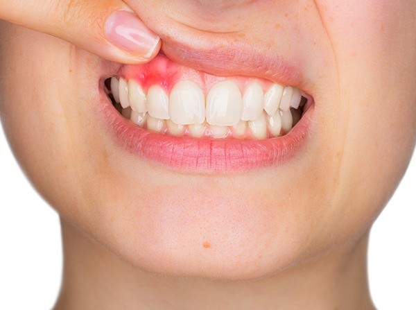 Closeup of red, inflamed gum tissue