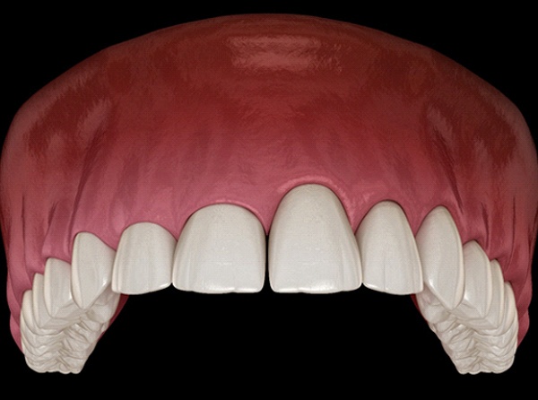 Illustration of teeth before and after gum recontouring