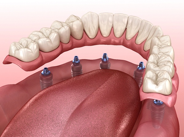 Illustration of lower arch implant dentures in Leesburg, VA