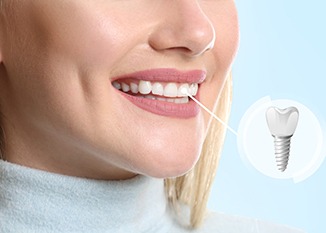 A woman who just had her dental implant’s restoration attached