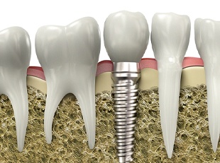 A digital image of a single tooth dental implant sitting between two healthy teeth