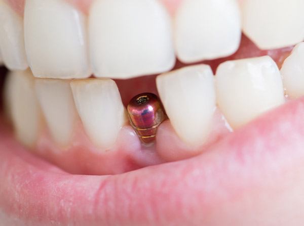 Dental implant visible on bottom arch of teeth