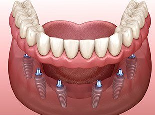 Animation of dental implant supported denture placement