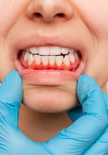 Blue-gloved hand pulling down corners of someone’s lips to reveal dark red gums
