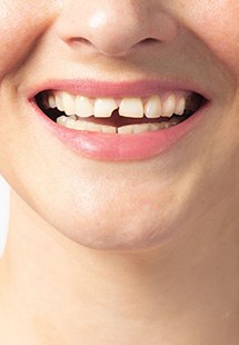 Repair and restore a broken tooth near Hamilton, VA