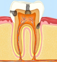 Infected tooth