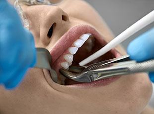 tooth extraction option when considering cost of root canal in Leesburg 