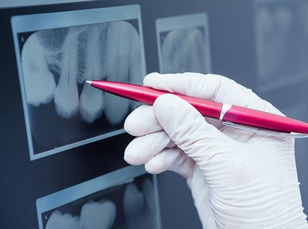 Pen pointing to dental x-ray