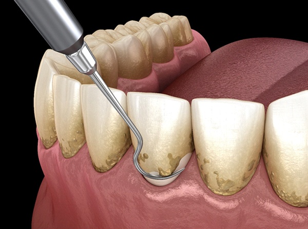 A digital image of a dental instrument being used to scrape away plaque and tartar accumulations on a tooth and near the gum line