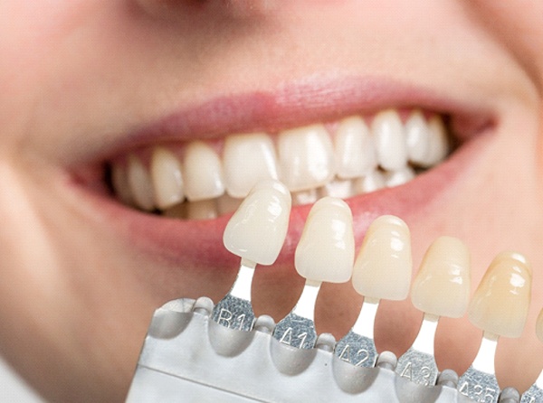 Closeup of veneers shades next to woman's smile