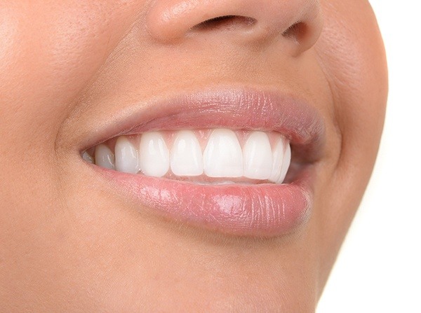Closeup of smile with Lumineers