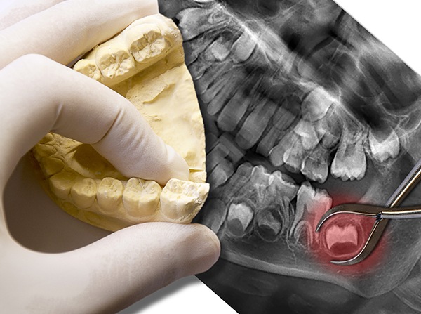 X-ray and model of smile with impacted wisdom tooth