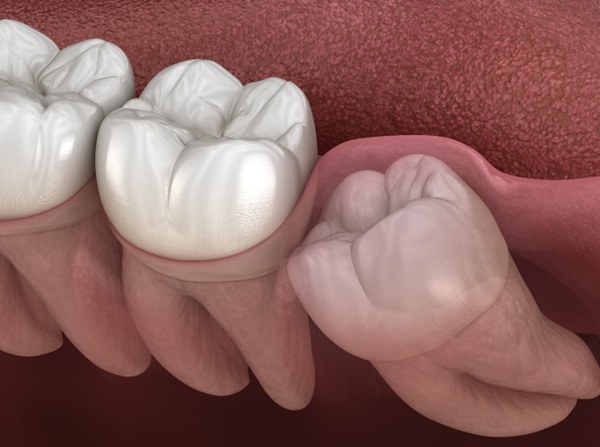 Illustration of an impacted wisdom tooth in Leesburg, VA
