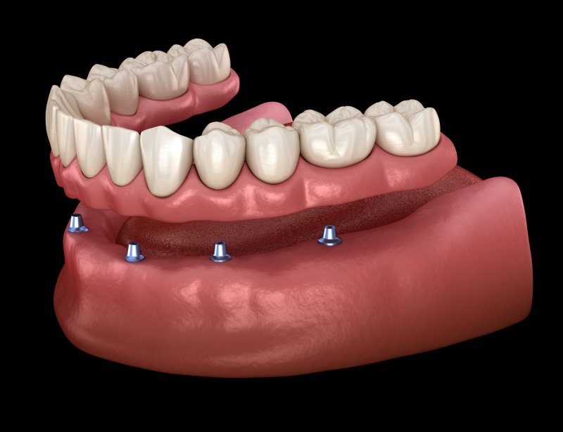  Illustration of dentures being placed on implants