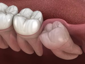 a digital image of impacted wisdom teeth