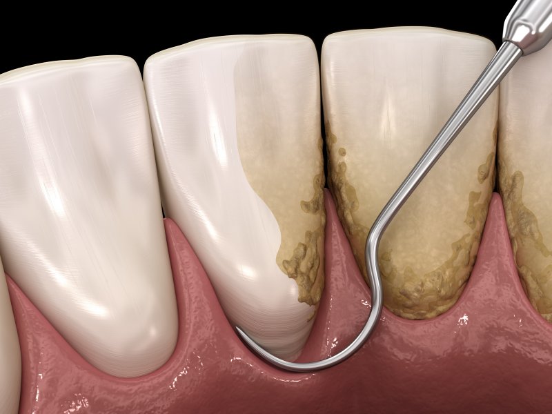 a digital image of a dental instrument being used to remove plaque and tartar accumulations during the scaling phase of treatment