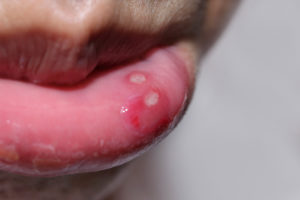 close of lip with canker sore