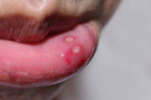 Sores on lips discount