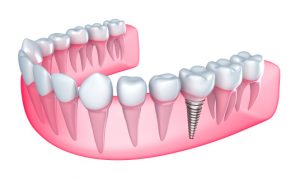 Dental implants in Leesburg are the key to oral health when you have missing teeth. 