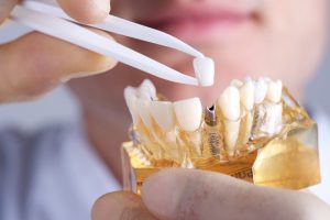Take care of your dental implants with Leesburg dentist Dr. Groy. 